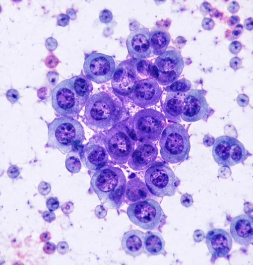 Prostate fine-needle aspiration cytology: a cohesive cluster of malignant epithelial cells with enlarged nuclei and prominent nucleoli, with dispersed cells in the surrounding field.