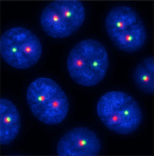 TMPRSS2–ERG FISH: interphase nuclei with DAPI counterstain showing separated red and green signals, consistent with a positive rearrangement.