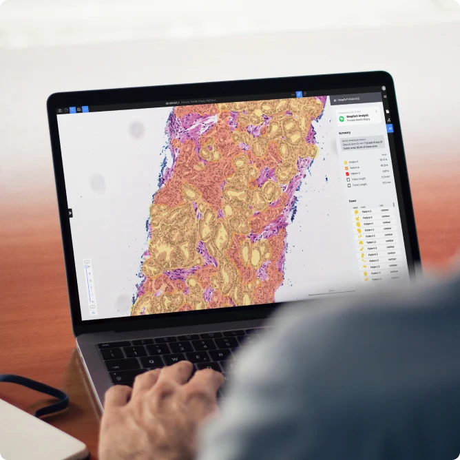 Deep Bio demonstration of digitized prostate tissue with colored analysis overlays and an analysis panel.
