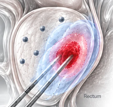 Sagittal anatomic map of the prostate showing an estimated tumor volume within the gland, with surrounding margin and negative systematic biopsy sites marked.